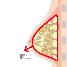 乳腺・脂肪組織は薄い皮膜で覆われています。これらの組織を膜ごと切開した部分から摘出します。