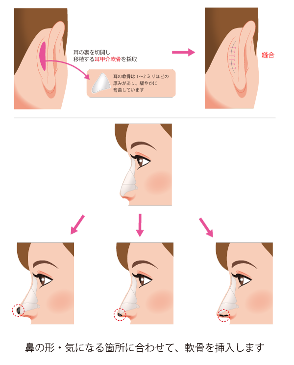 鼻中隔延長の施術方