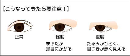 眼瞼下垂の主な症状