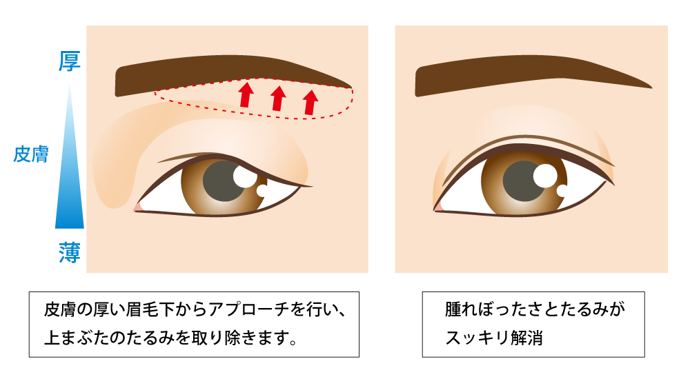 目の上のたるみ取り 公式 アテナクリニック東京銀座の美容整形外科