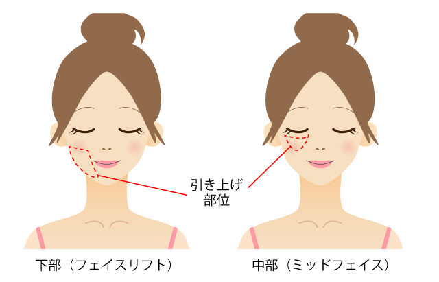フェイスリフト 公式 アテナクリニック東京銀座の美容整形外科 フェイスリフト 公式 アテナクリニック東京銀座の美容整形外科