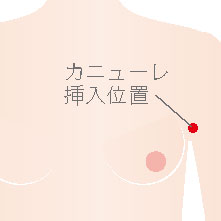 乳腺は切除せずに、脂肪を吸引します。乳腺が少なく脂肪が多い方や、バストのボリュームを少しだけ減らしたい方が適応になります。ワキの下から吸引管を挿入して脂肪を取り除きます。脂肪と乳腺の割合にもよりますが、仕上がりは元のバストの半分程度になります。ほとんどの場合手術後皮膚のたるみは出ますが、時間と共にたるみは消えていきます。半年~一年ほど様子を見て頂きます。その時に皮膚のたるみが気になるようでしたら皮膚の切除をお考えいただきたいと思います。