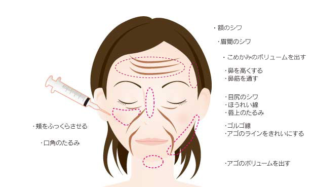 ヒアルロン酸注入 公式 アテナクリニック東京銀座の美容整形外科
