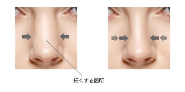 鼻筋を細くする 鼻骨削り プロテーゼ挿入 鷲鼻修正 公式 アテナクリニック東京銀座の美容整形外科
