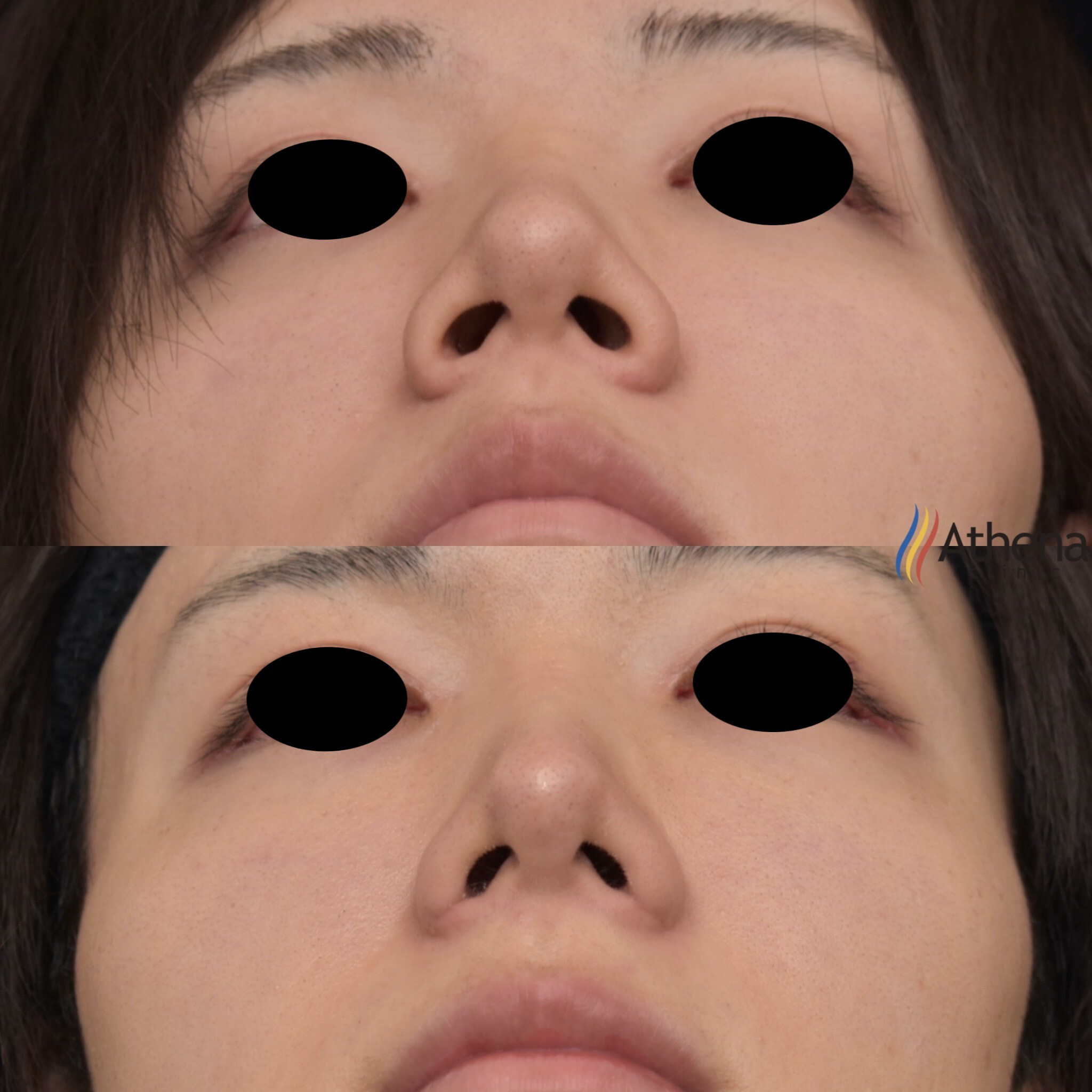 鼻翼 