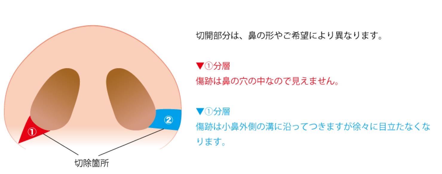 鼻の穴を小さくする（鼻翼縮小）｜【公式】アテナクリニック東京銀座の