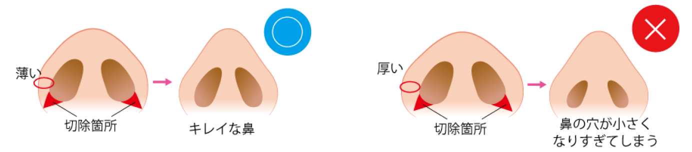 鼻の穴を小さくする（鼻翼縮小）｜【公式】アテナクリニック東京銀座の