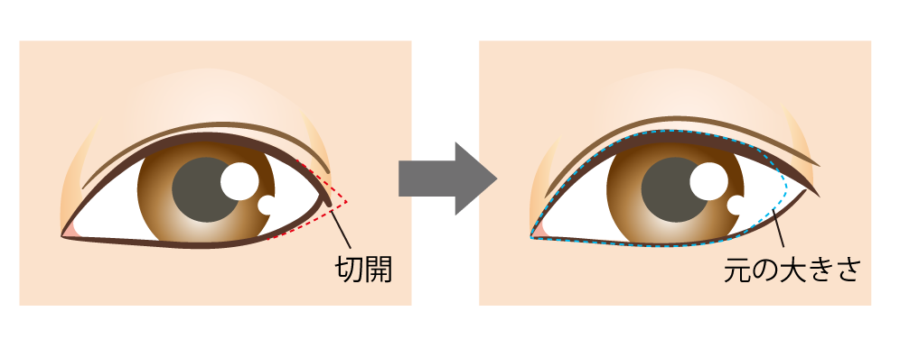 目尻切開法 公式 アテナクリニック東京銀座の美容整形外科